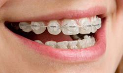 What You Need to Know About Lingual Braces - Brimhall Dental Group